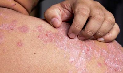 Psoriasis