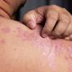 Psoriasis