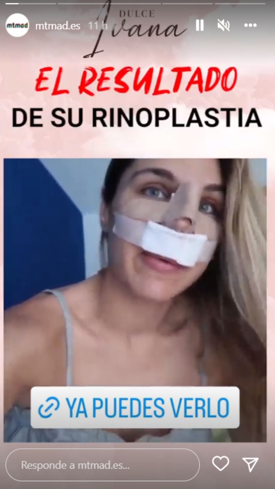 Ivana Icardi Antes y Despues Rinoplastia Operacion de Nariz
